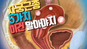 Read more about the article 자궁근종 의심된다면 알아야 할 5가지